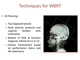 Management of brain metastases | PPTX
