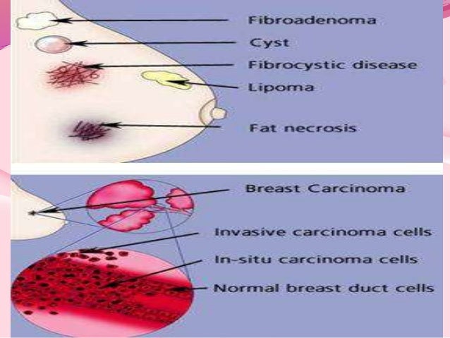 lump on chest management of breast lumps with awareness to breast carcinoma إyusor lump on chest management of breast lumps with awareness to breast carcinoma إyusor