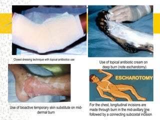 MANAGEMENT OF BURN by Dr, Astatekee.pptx