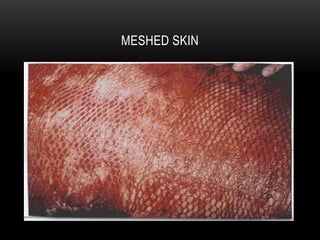 Brazen Skin Example Management of burn injuries | PPTX