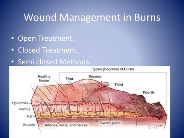 Management of burns | PPTX