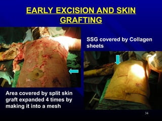 Mesh Excision MANAGEMENT OF BURNS with Classifications | PPT