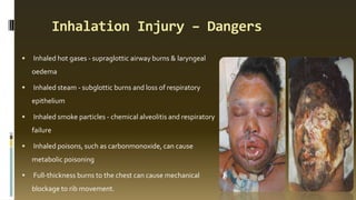 Inhalation Injury
RECOGNITION INITIAL MANAGEMENT
 A history of being trapped in the presence of
smoke or hot gases.
 Bur...