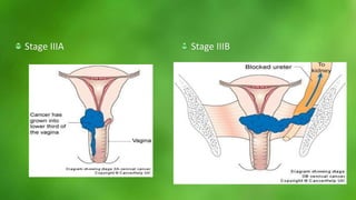 Stage IIIA Stage IIIB 
 