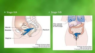 Stage IVA Stage IVB 
 