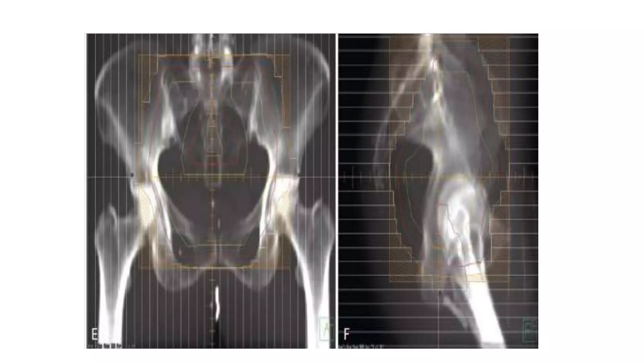 Management of ca endometrium