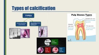 Management of calcified canals for endod | PPTX