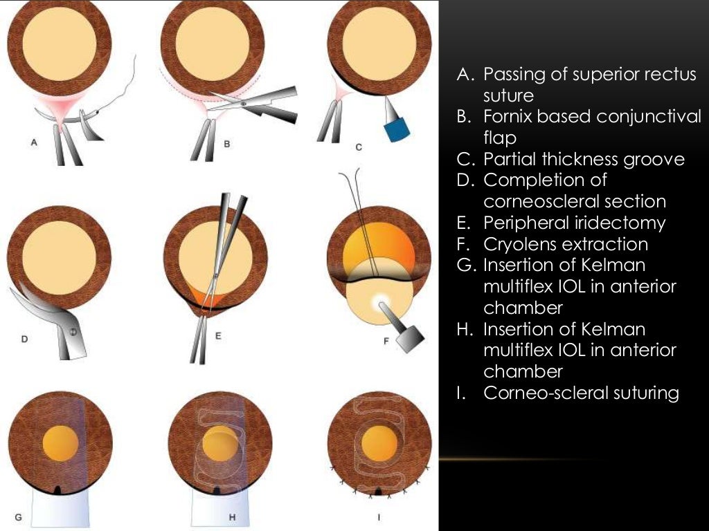 Management of Cataract