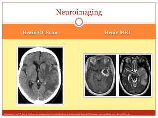Management of Cerebral Edema in Brain Tumors | PPTX