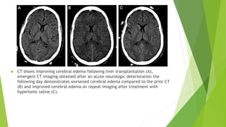 Management of Cerebral edema 1 [Autosaved].pptx