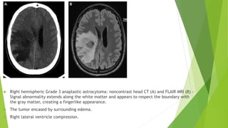 Management of Cerebral edema 1 [Autosaved].pptx
