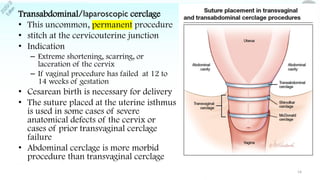 Management of cervical insufficiency | PDF