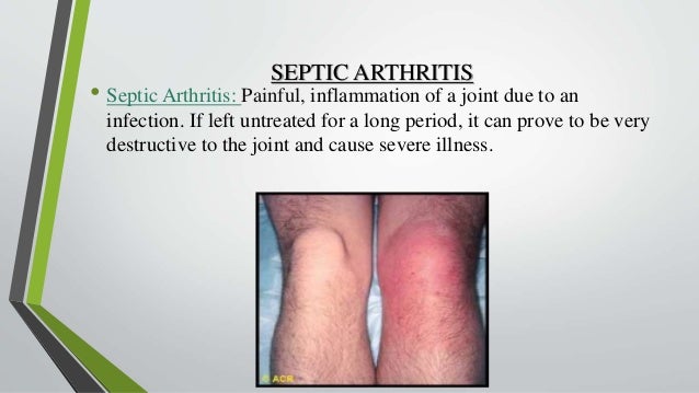 Arthroscopy: Management of chronic septic arthritis