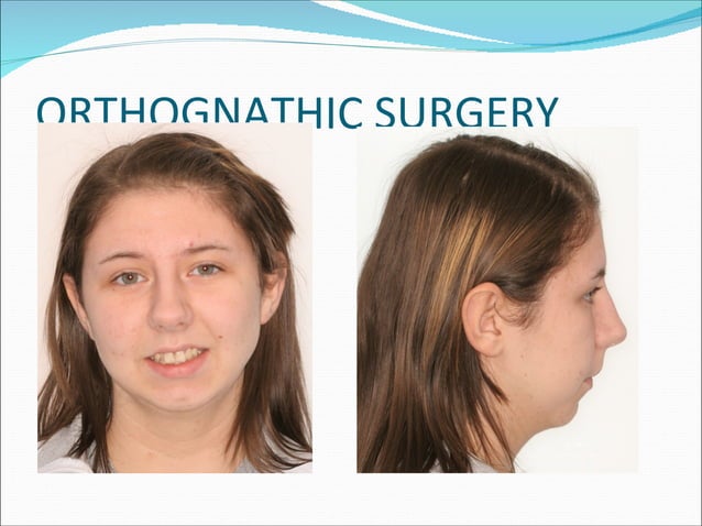 Management of class ii division 1 malocclusion | PPT