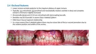 Comprehensive Overview of Class II Division 2 Malocclusions: Diagnosis ...