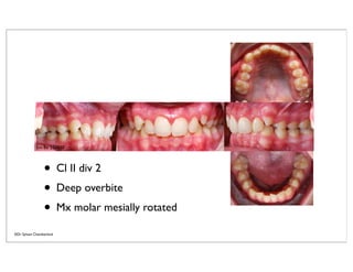 Part II-Management of class ii malocclusion with speed appliance part ...