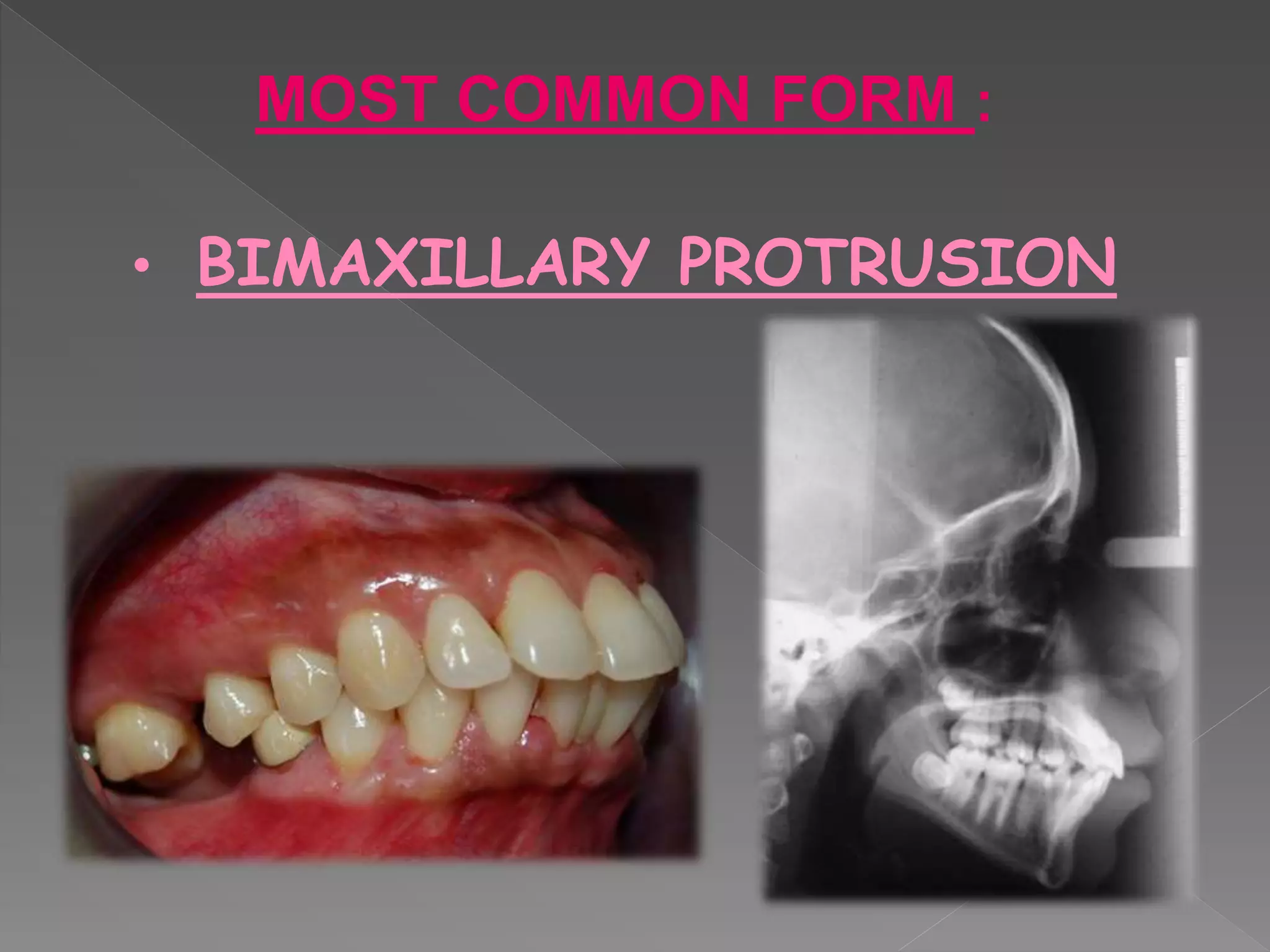 MOST COMMON FORM :
• BIMAXILLARY PROTRUSION
 