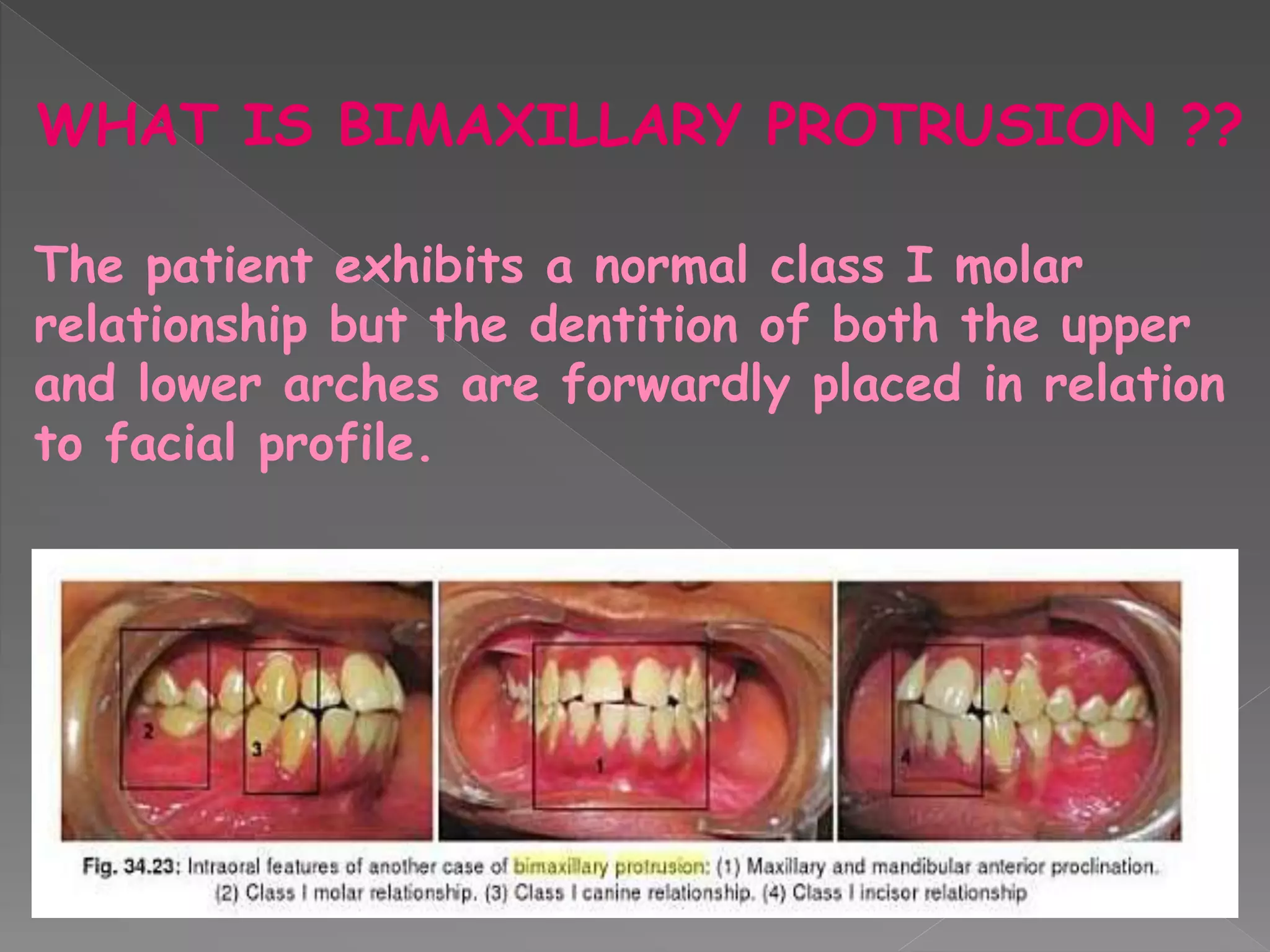 WHAT IS BIMAXILLARY PROTRUSION ??
The patient exhibits a normal class I molar
relationship but the dentition of both the upper
and lower arches are forwardly placed in relation
to facial profile.
 