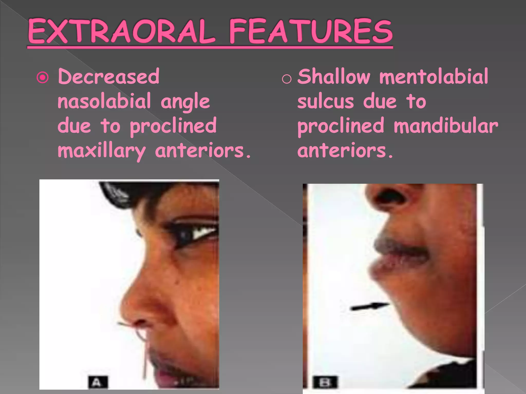  Decreased
nasolabial angle
due to proclined
maxillary anteriors.
o Shallow mentolabial
sulcus due to
proclined mandibular
anteriors.
 