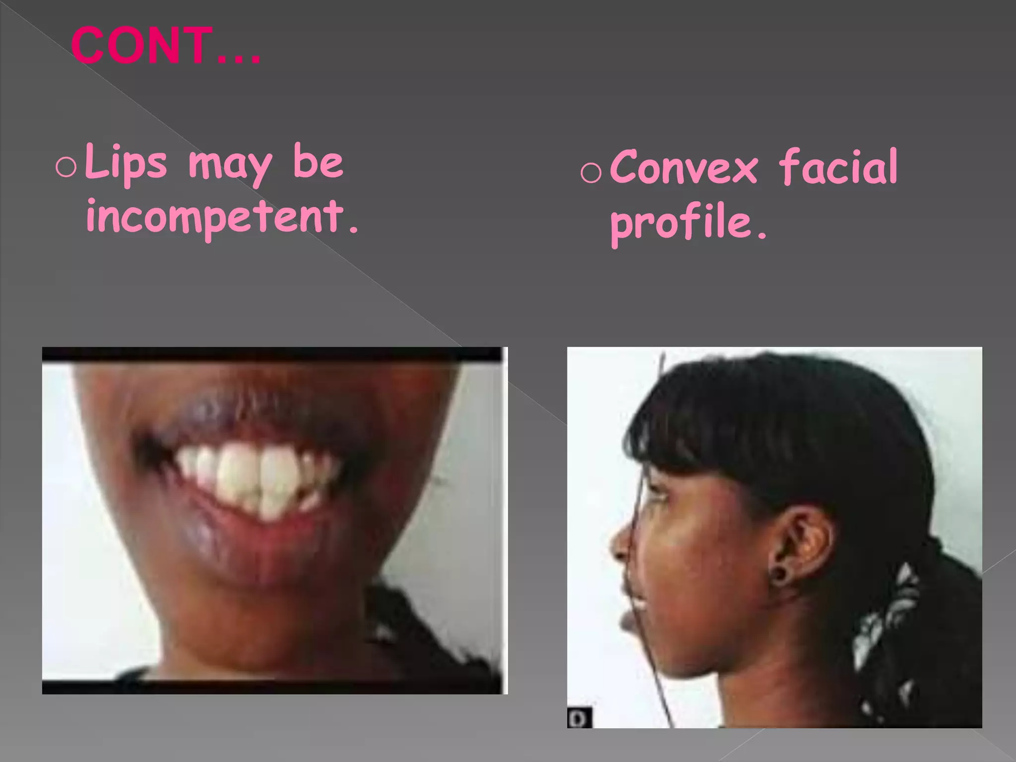 oLips may be
incompetent.
oConvex facial
profile.
CONT…
 