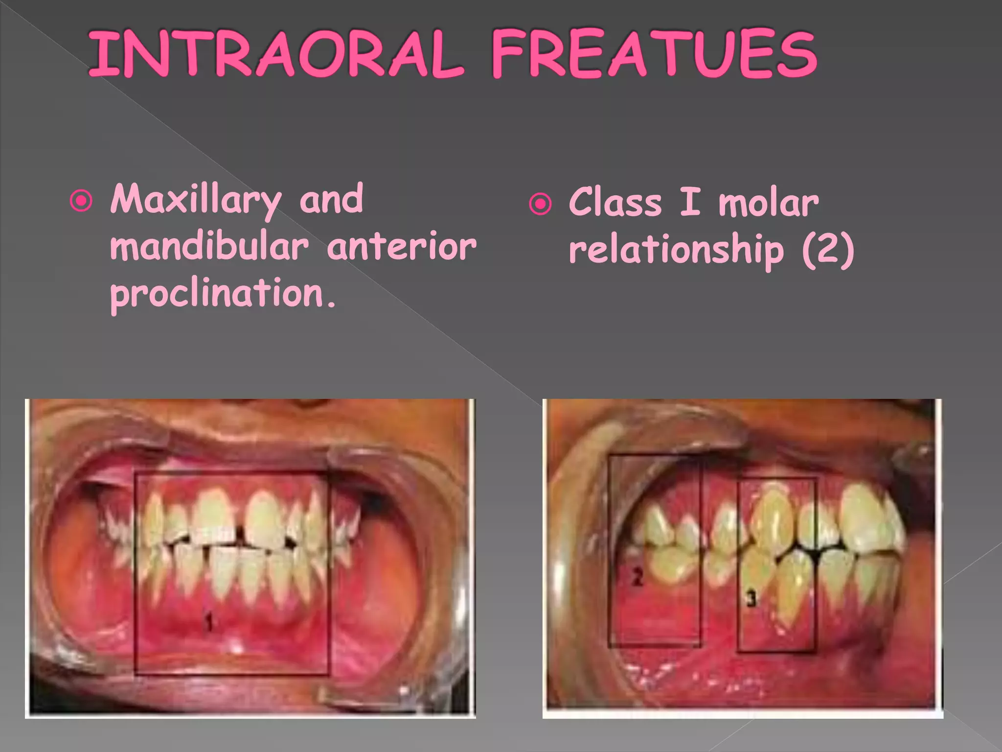  Maxillary and
mandibular anterior
proclination.
 Class I molar
relationship (2)
 