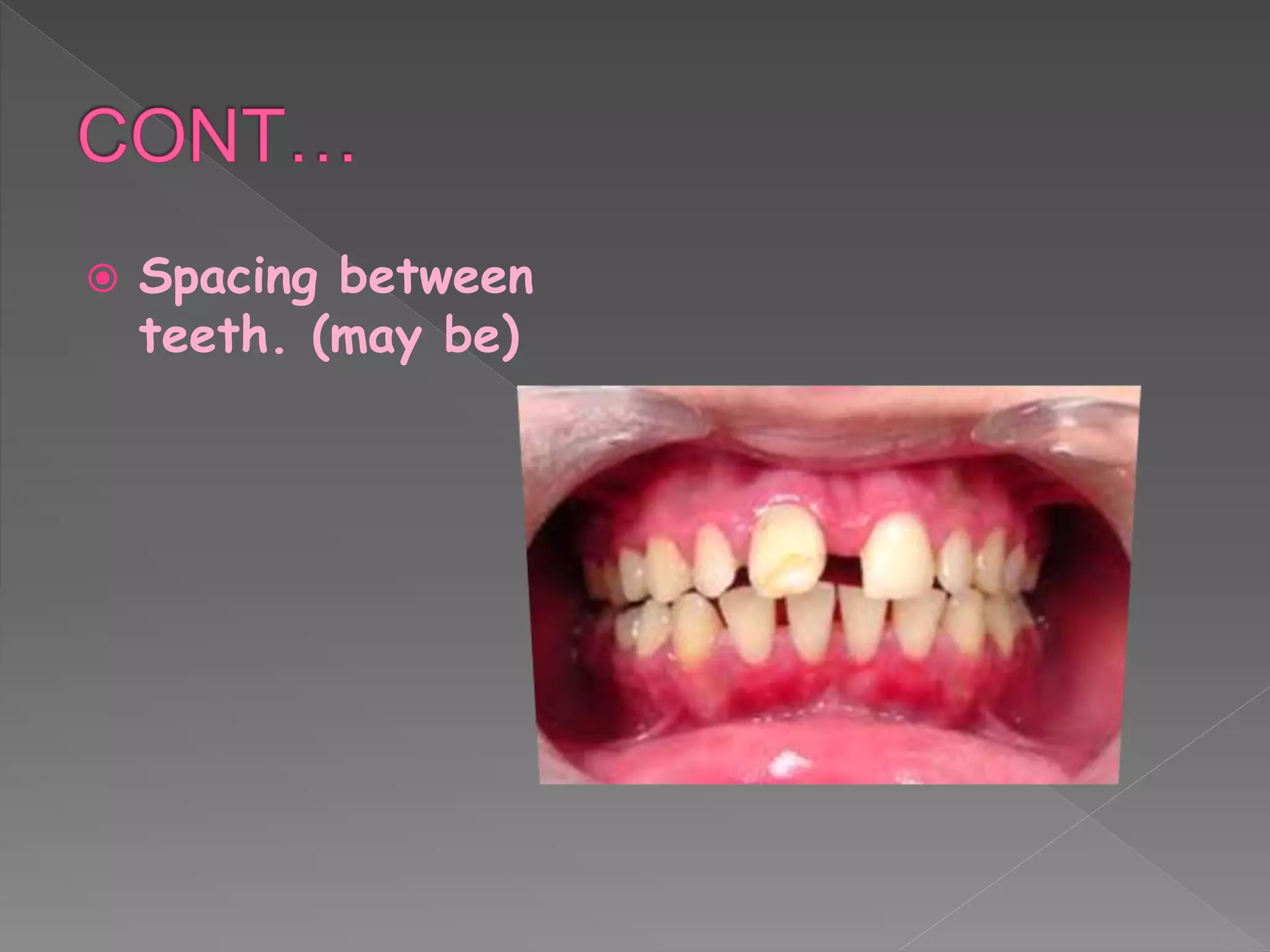  Spacing between
teeth. (may be)
 