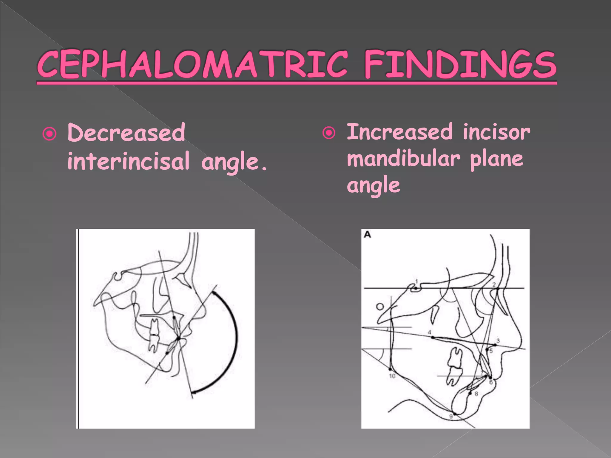  Decreased
interincisal angle.
 Increased incisor
mandibular plane
angle
 
