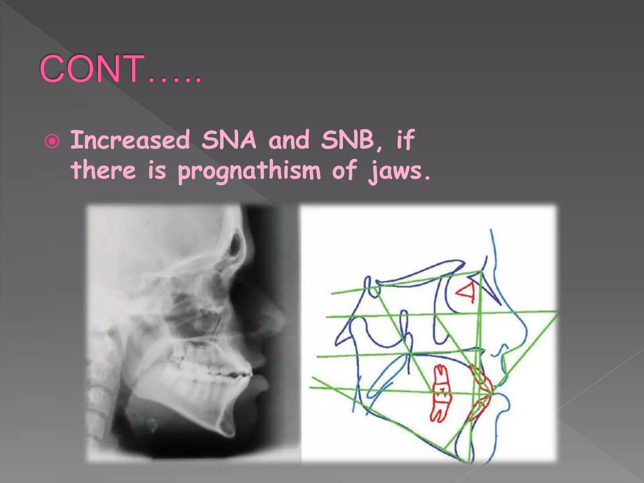  Increased SNA and SNB, if
there is prognathism of jaws.
 