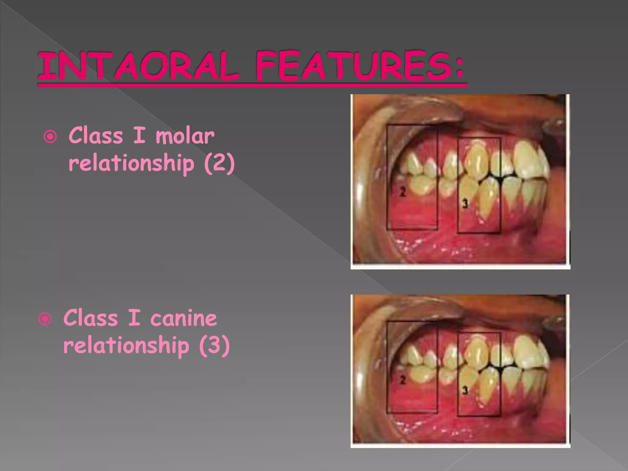  Class I molar
relationship (2)
 Class I canine
relationship (3)
 