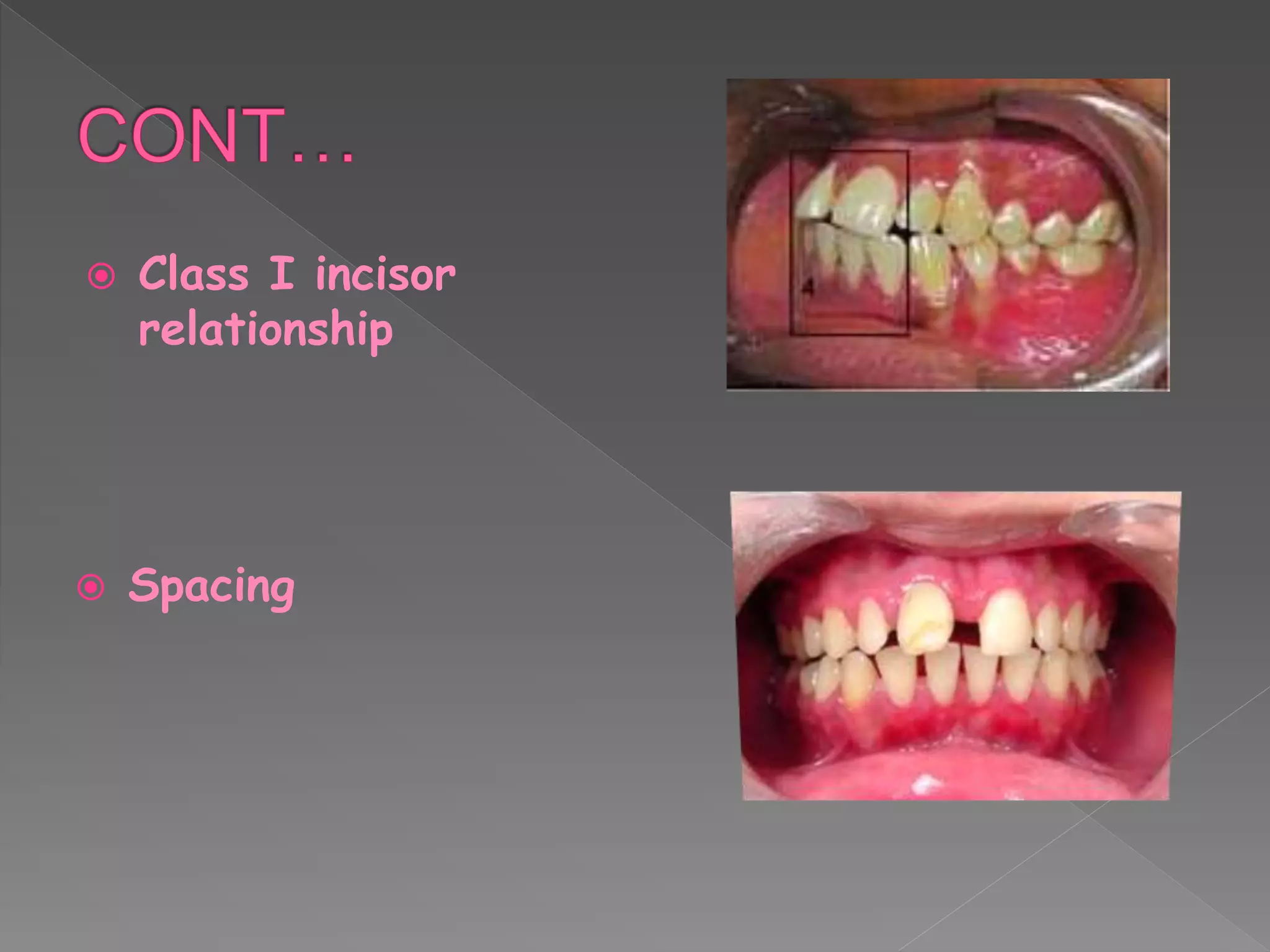  Class I incisor
relationship
 Spacing
 