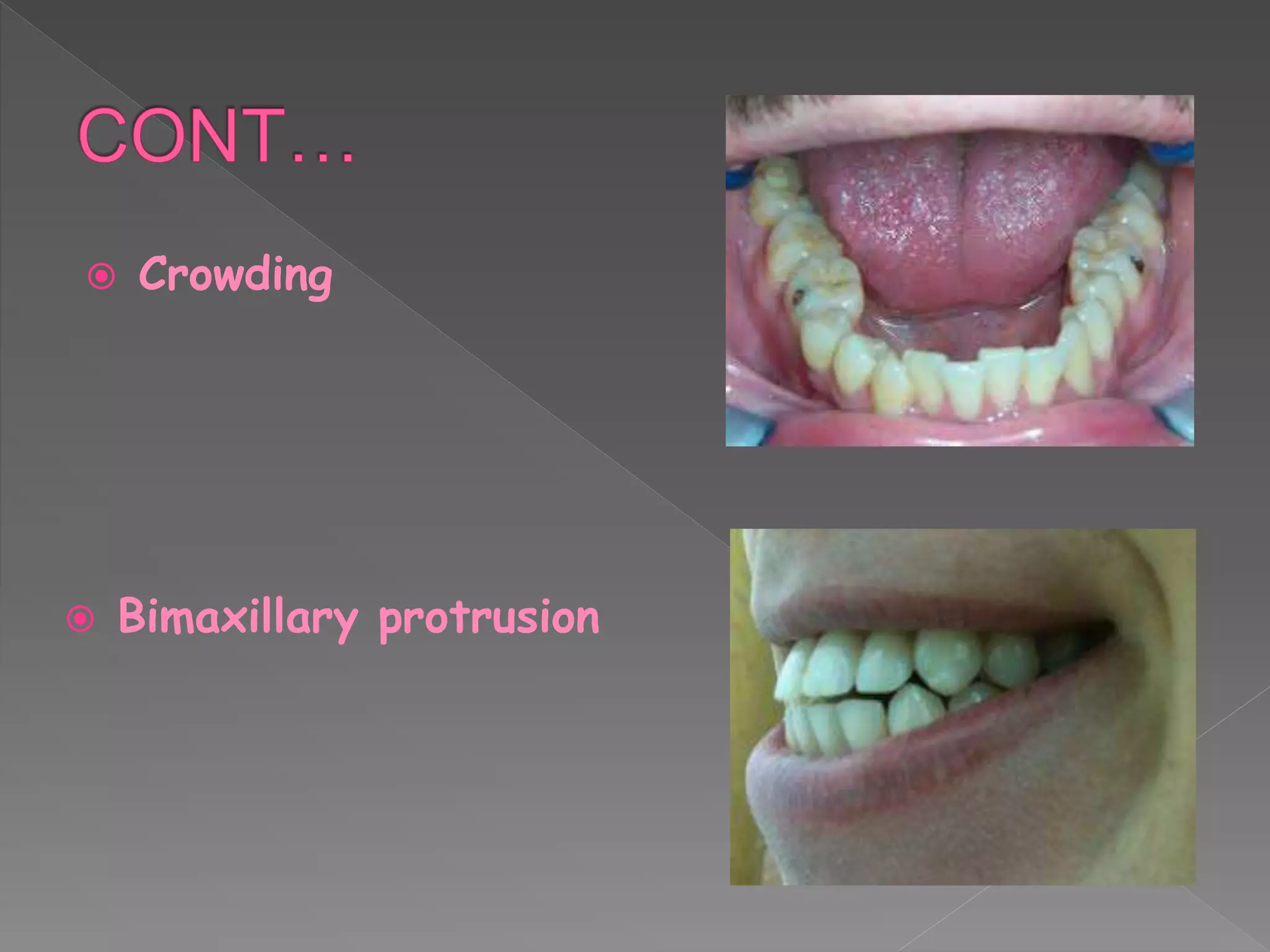  Crowding
 Bimaxillary protrusion
 