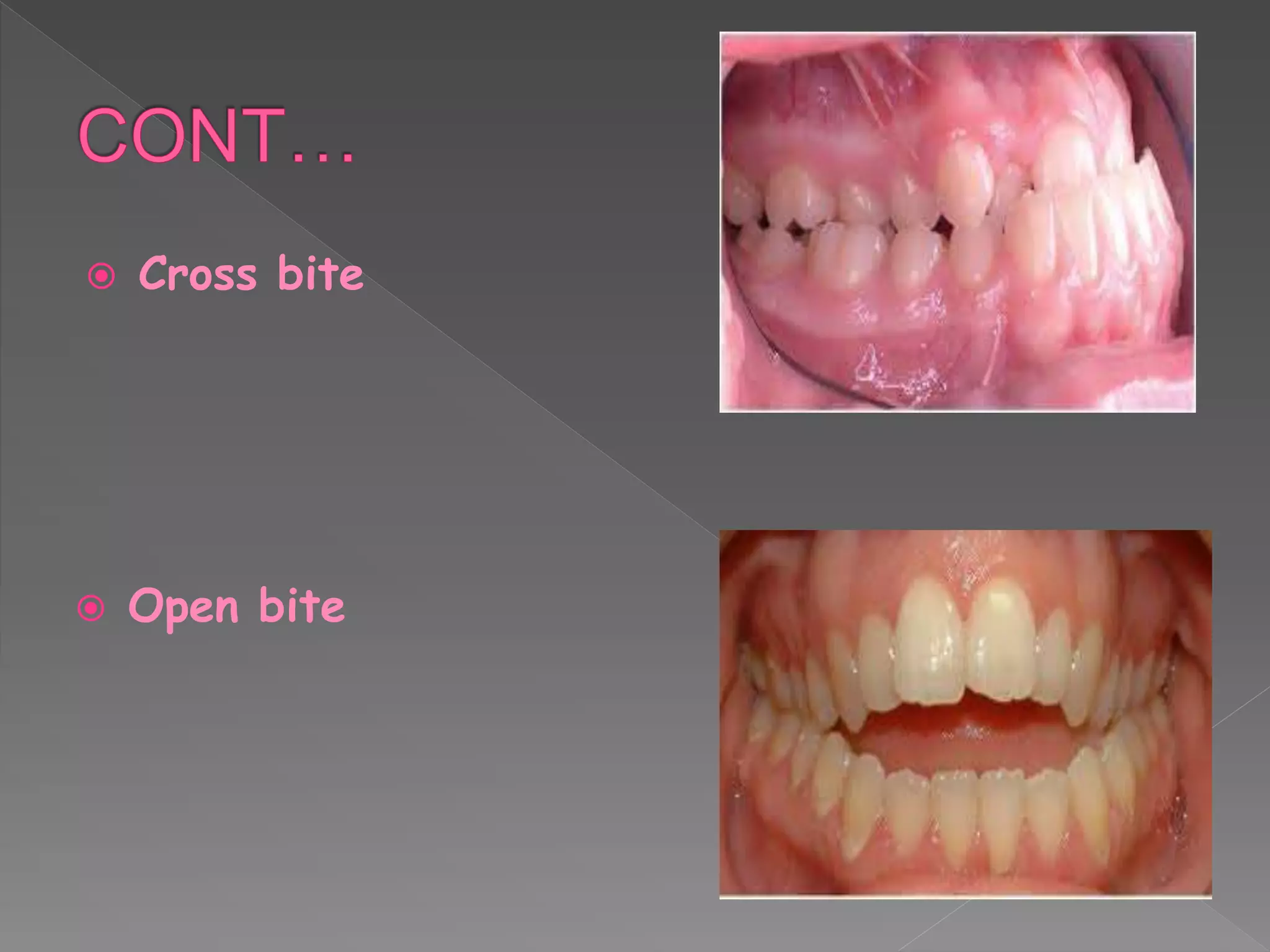  Cross bite
 Open bite
 