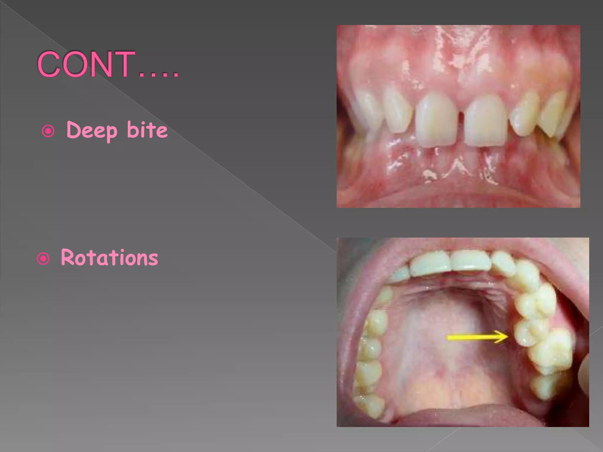  Deep bite
 Rotations
 