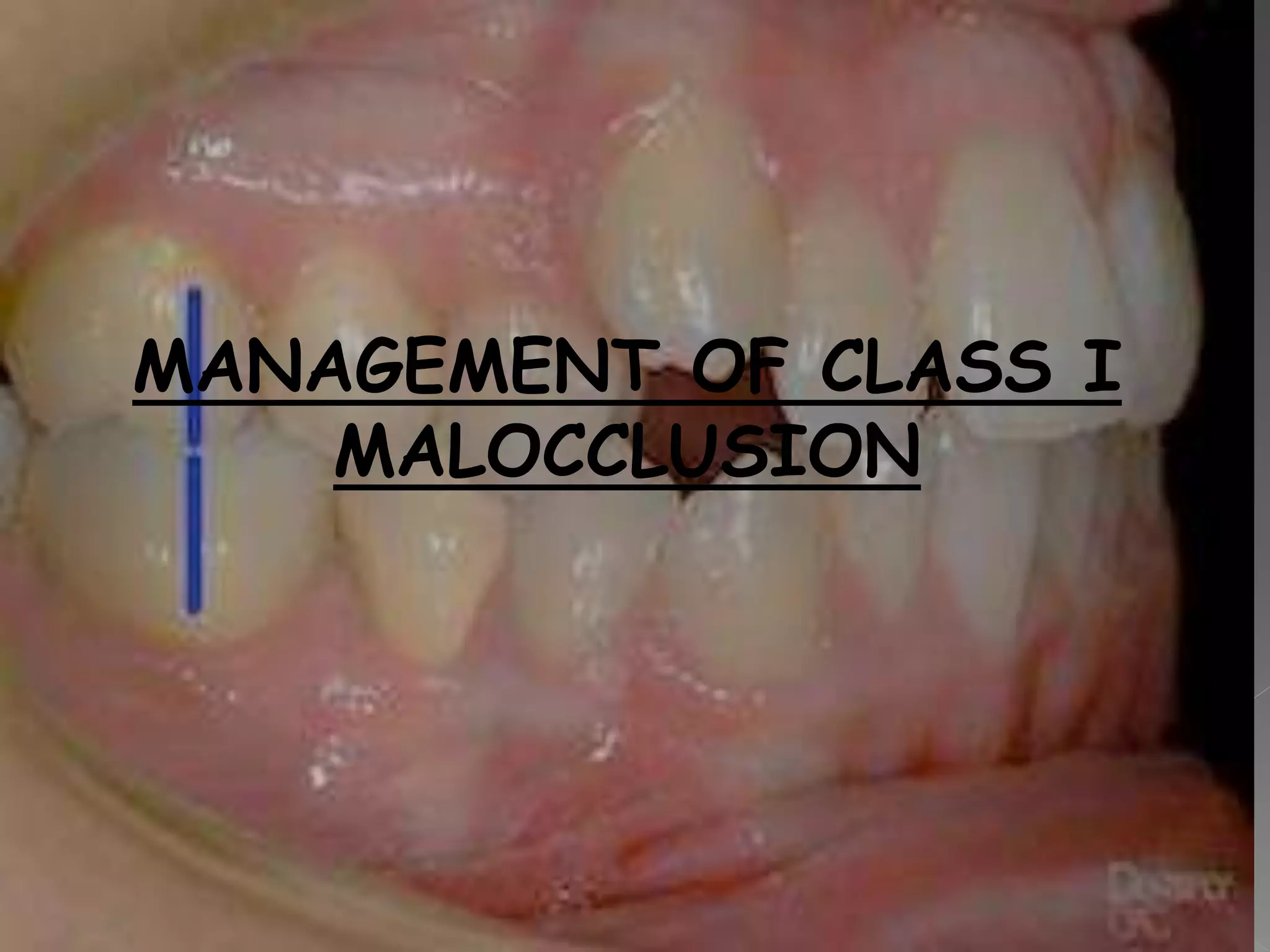 MANAGEMENT OF CLASS I
MALOCCLUSION
 