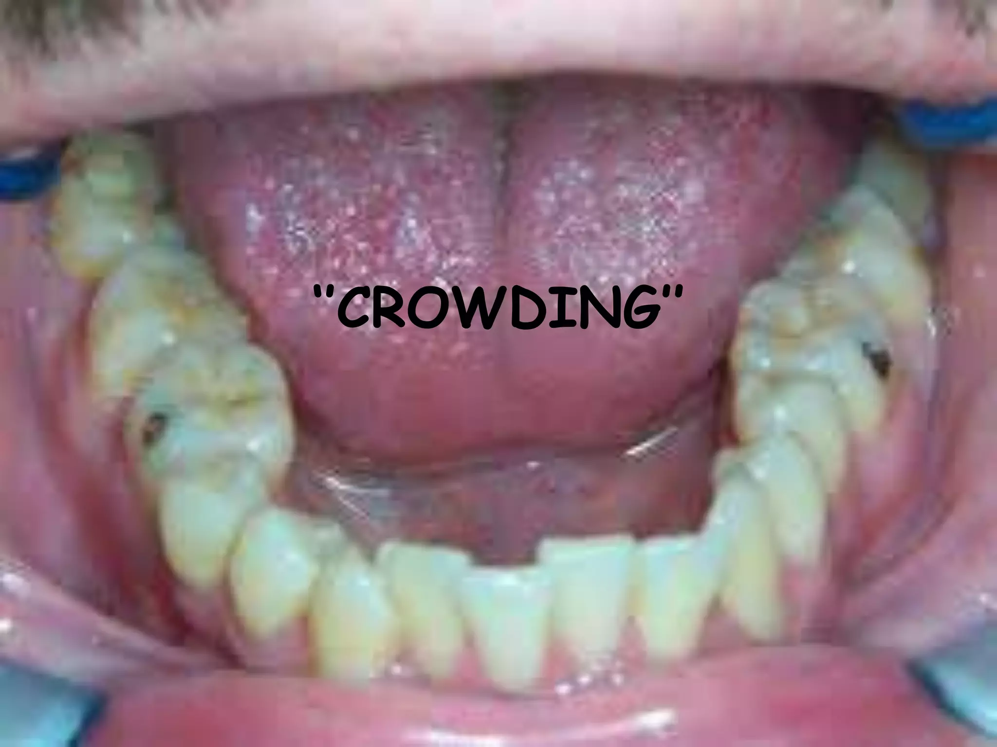 ‘’CROWDING’’
 