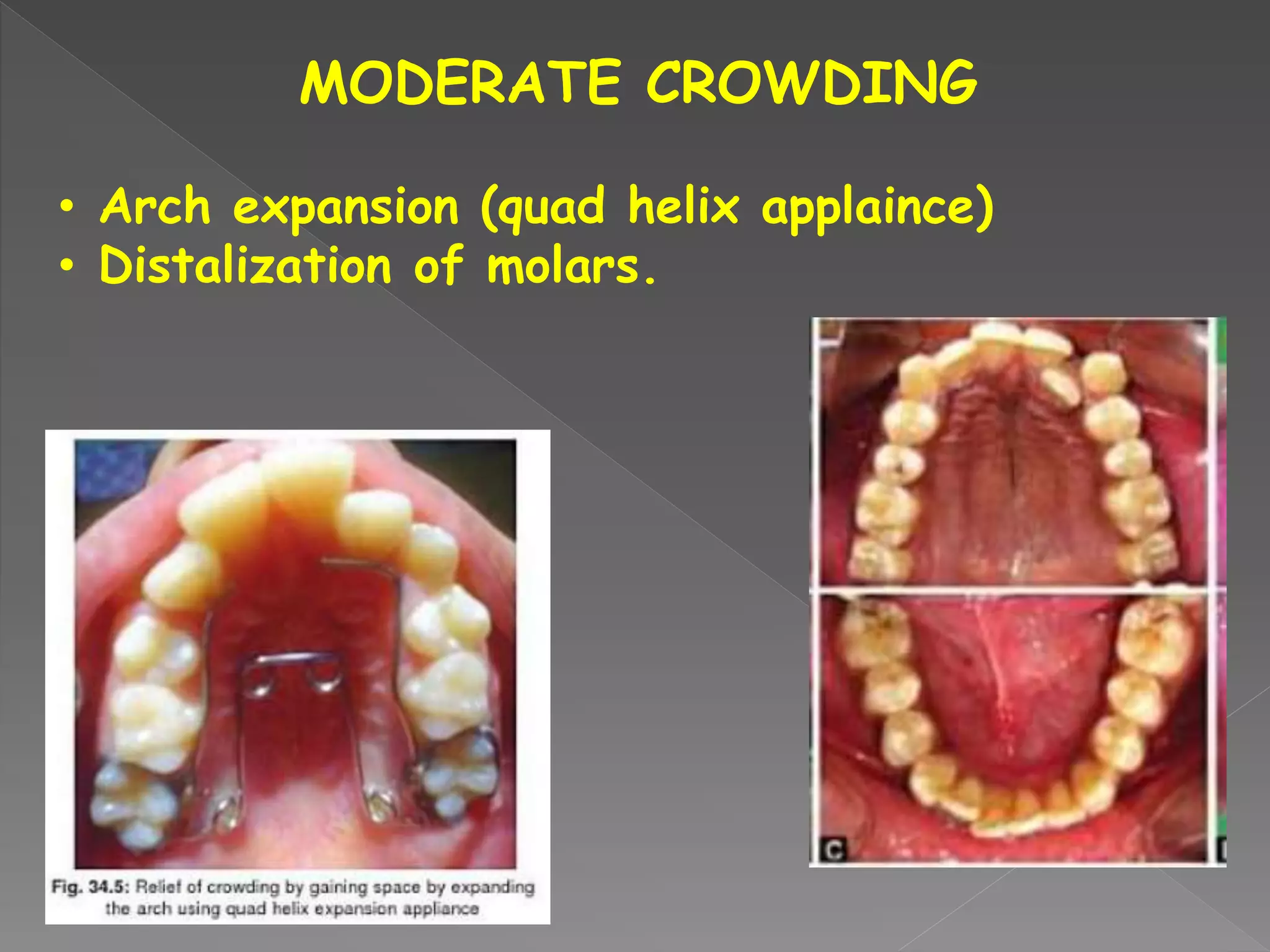 MODERATE CROWDING
• Arch expansion (quad helix applaince)
• Distalization of molars.
 