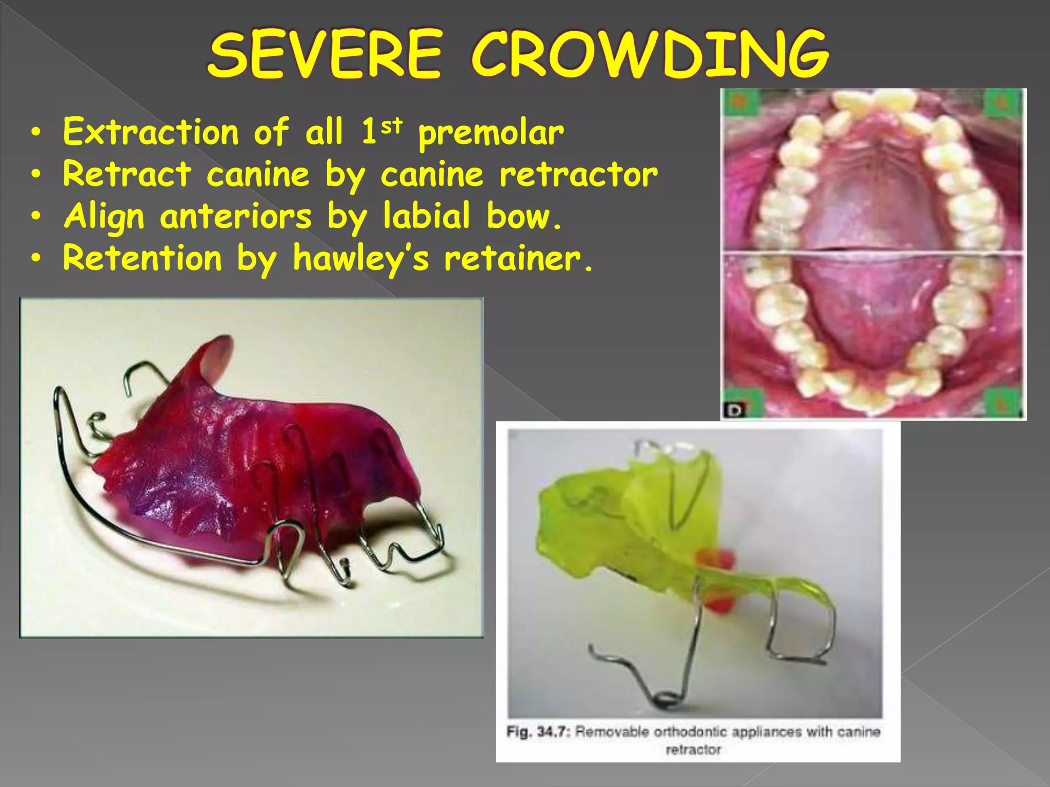 • Extraction of all 1st premolar
• Retract canine by canine retractor
• Align anteriors by labial bow.
• Retention by hawley’s retainer.
 