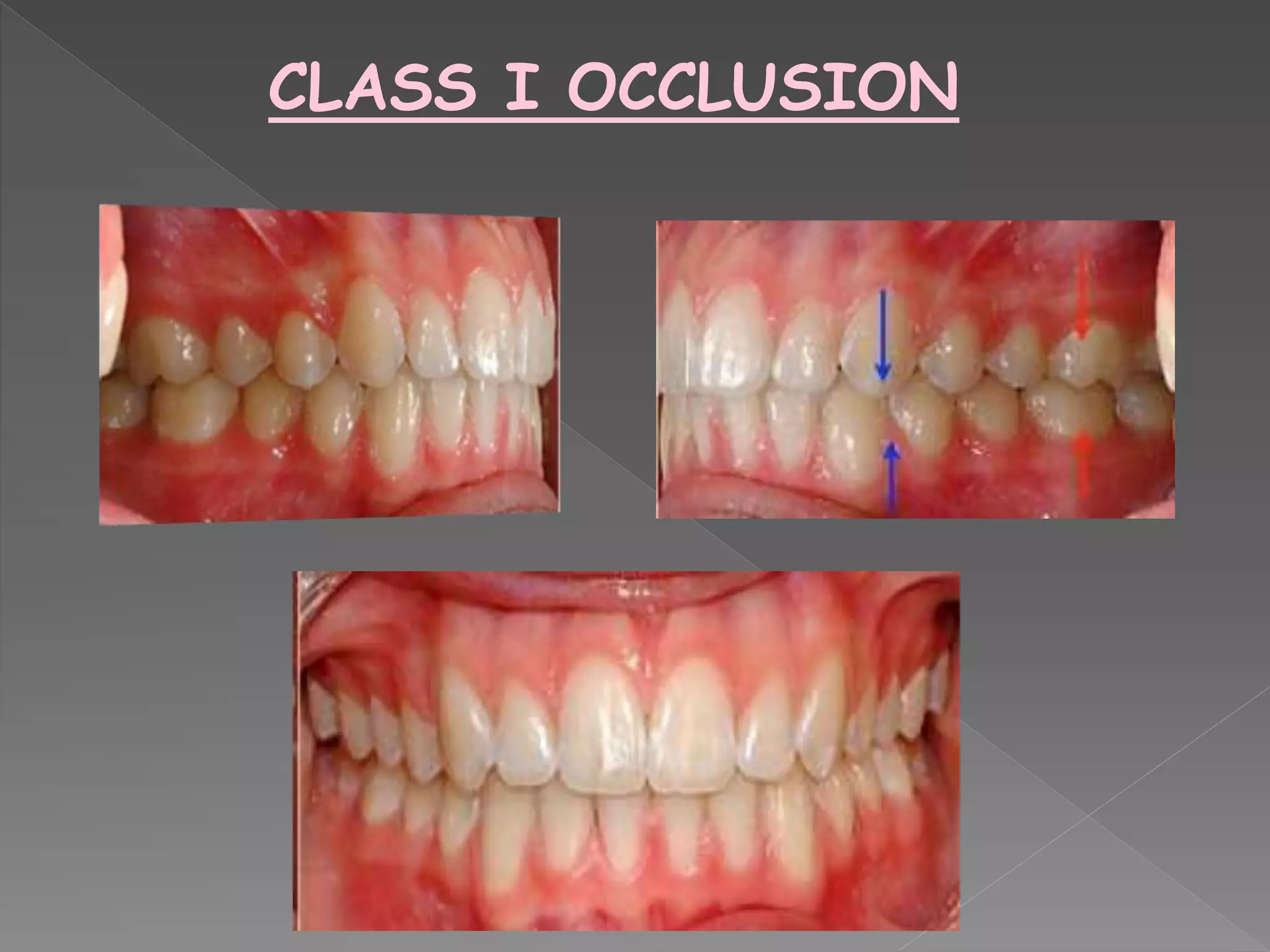 CLASS I OCCLUSION
 