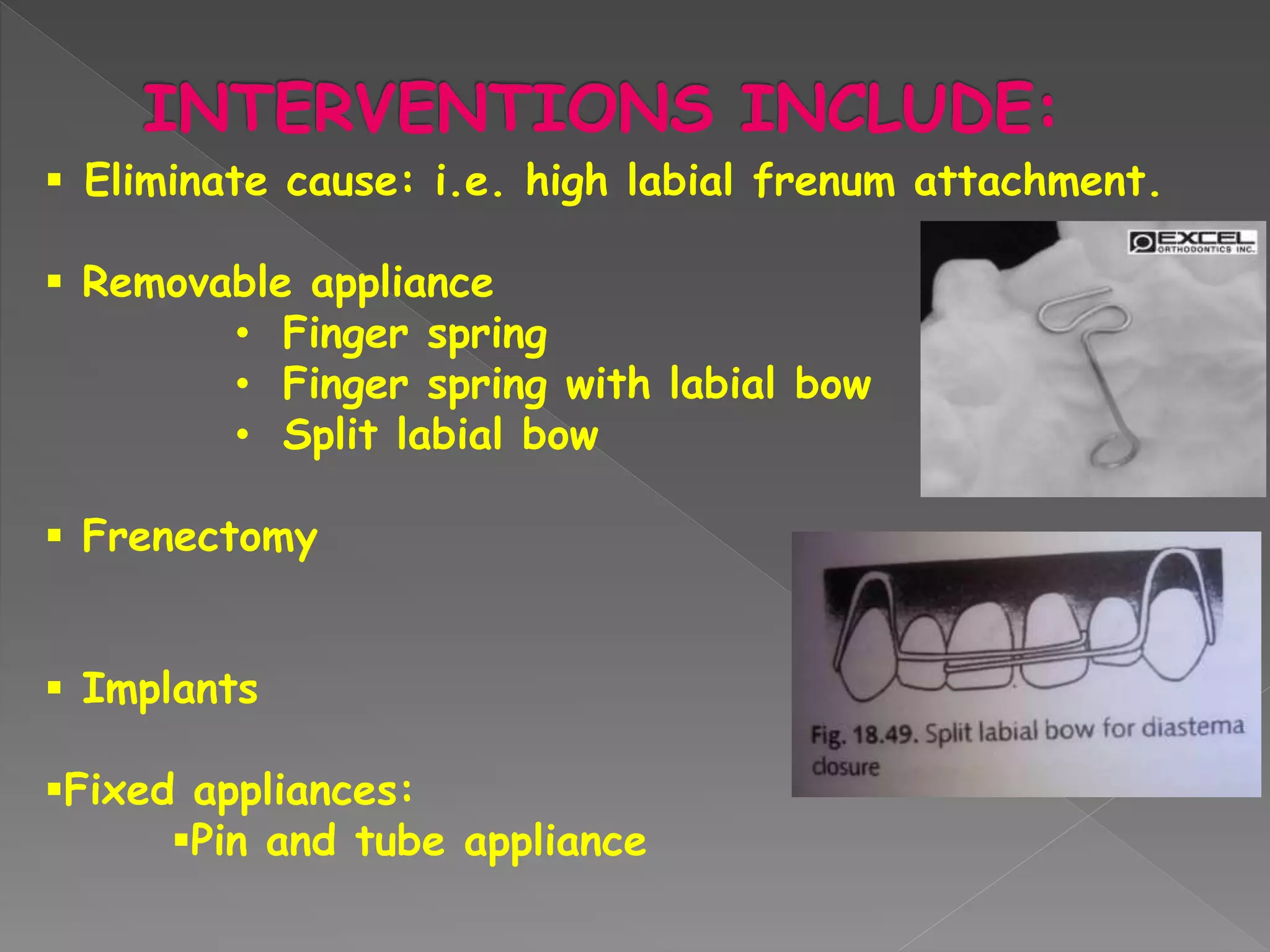  Eliminate cause: i.e. high labial frenum attachment.
 Removable appliance
• Finger spring
• Finger spring with labial bow
• Split labial bow
 Frenectomy
 Implants
Fixed appliances:
Pin and tube appliance
 