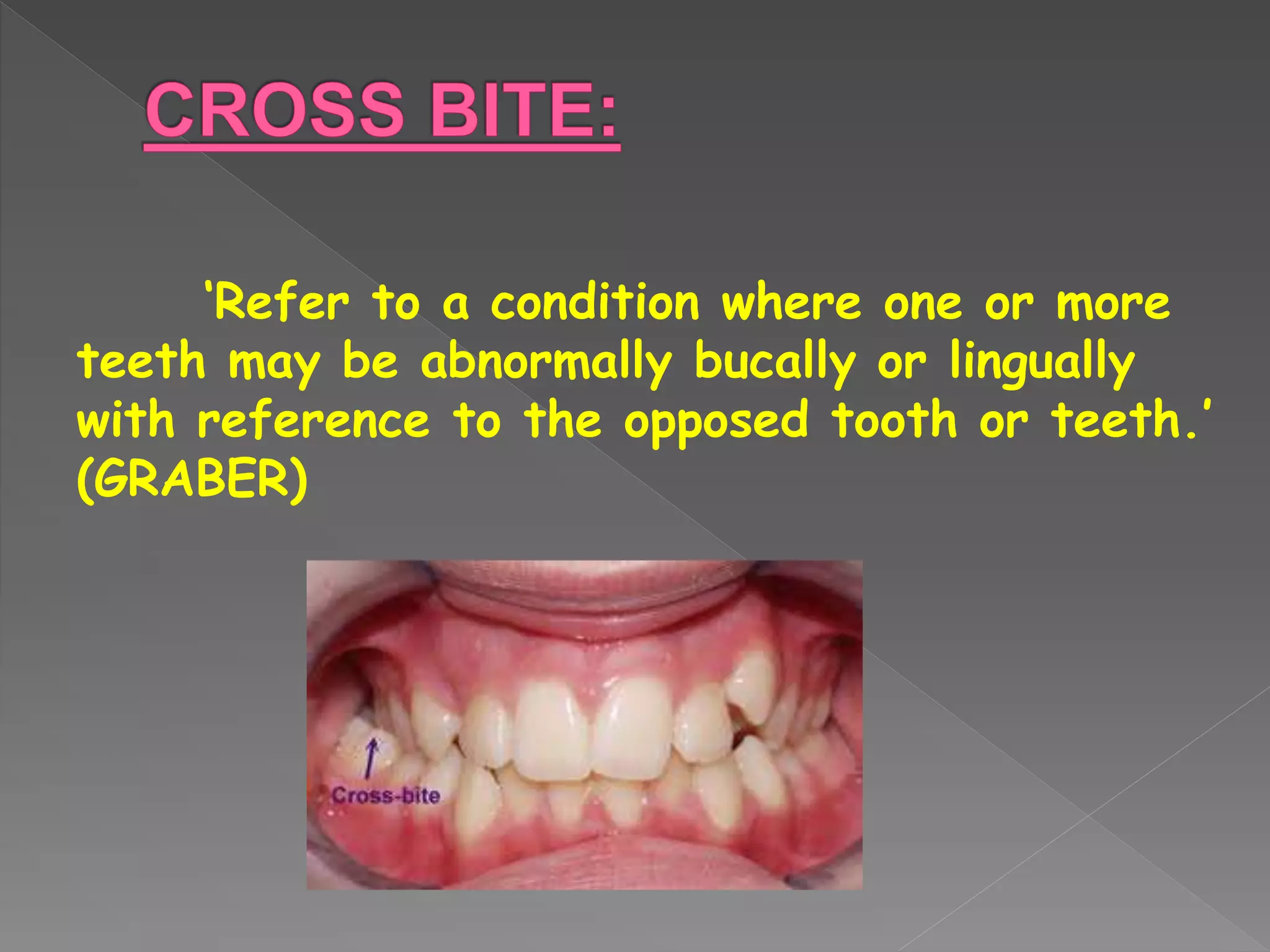 ‘Refer to a condition where one or more
teeth may be abnormally bucally or lingually
with reference to the opposed tooth or teeth.’
(GRABER)
 