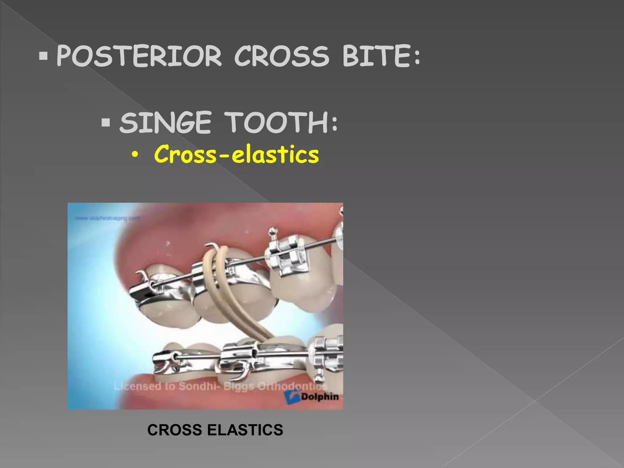  POSTERIOR CROSS BITE:
 SINGE TOOTH:
• Cross-elastics
CROSS ELASTICS
 
