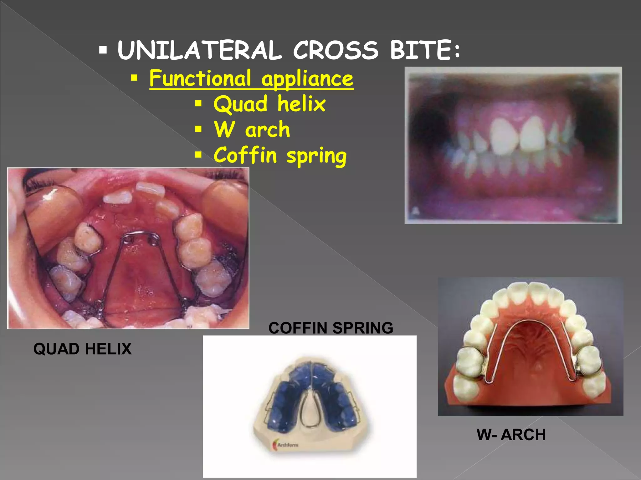  UNILATERAL CROSS BITE:
 Functional appliance
 Quad helix
 W arch
 Coffin spring
QUAD HELIX
W- ARCH
COFFIN SPRING
 