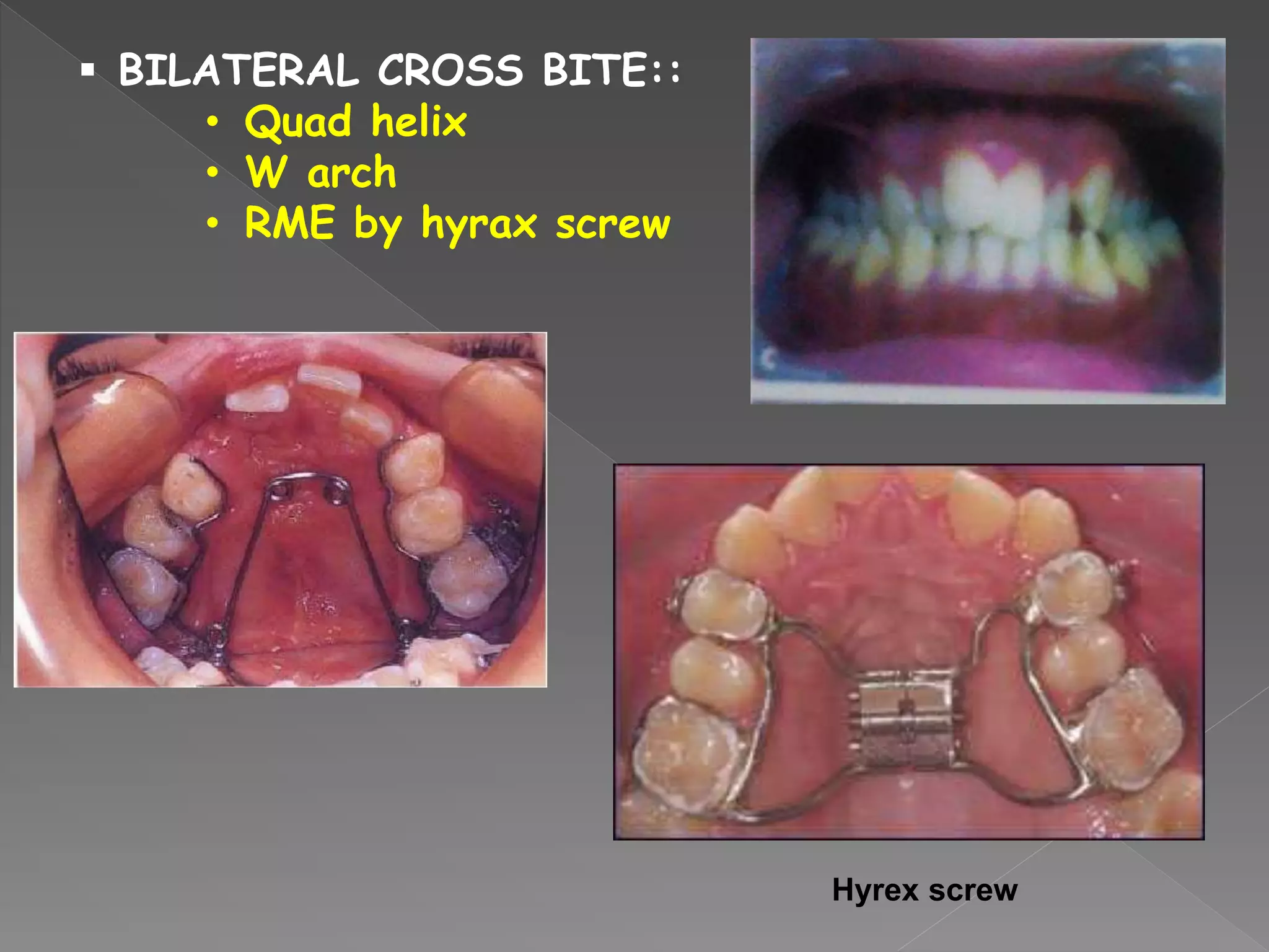  BILATERAL CROSS BITE::
• Quad helix
• W arch
• RME by hyrax screw
Hyrex screw
 