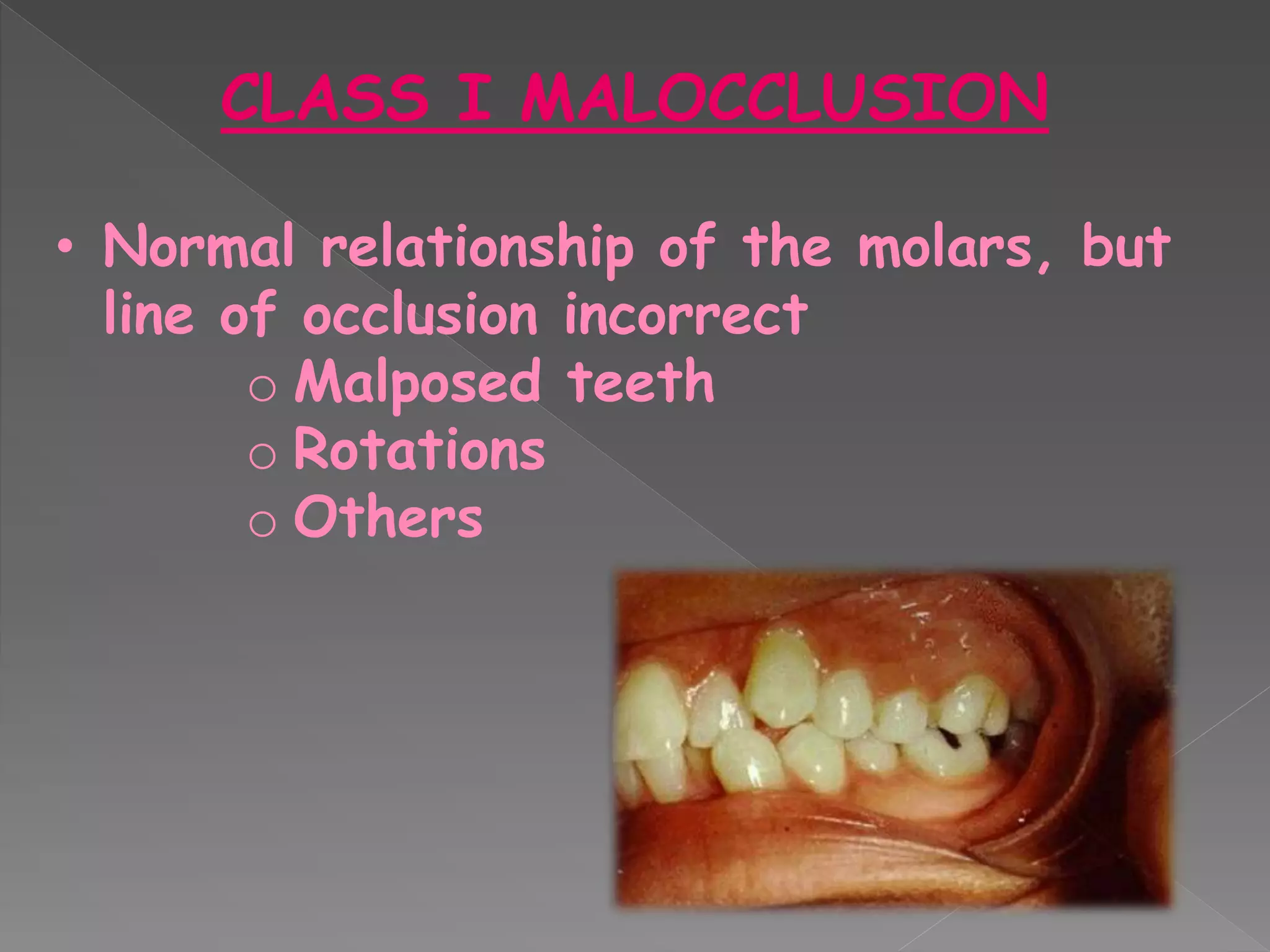 CLASS I MALOCCLUSION
• Normal relationship of the molars, but
line of occlusion incorrect
o Malposed teeth
o Rotations
o Others
 