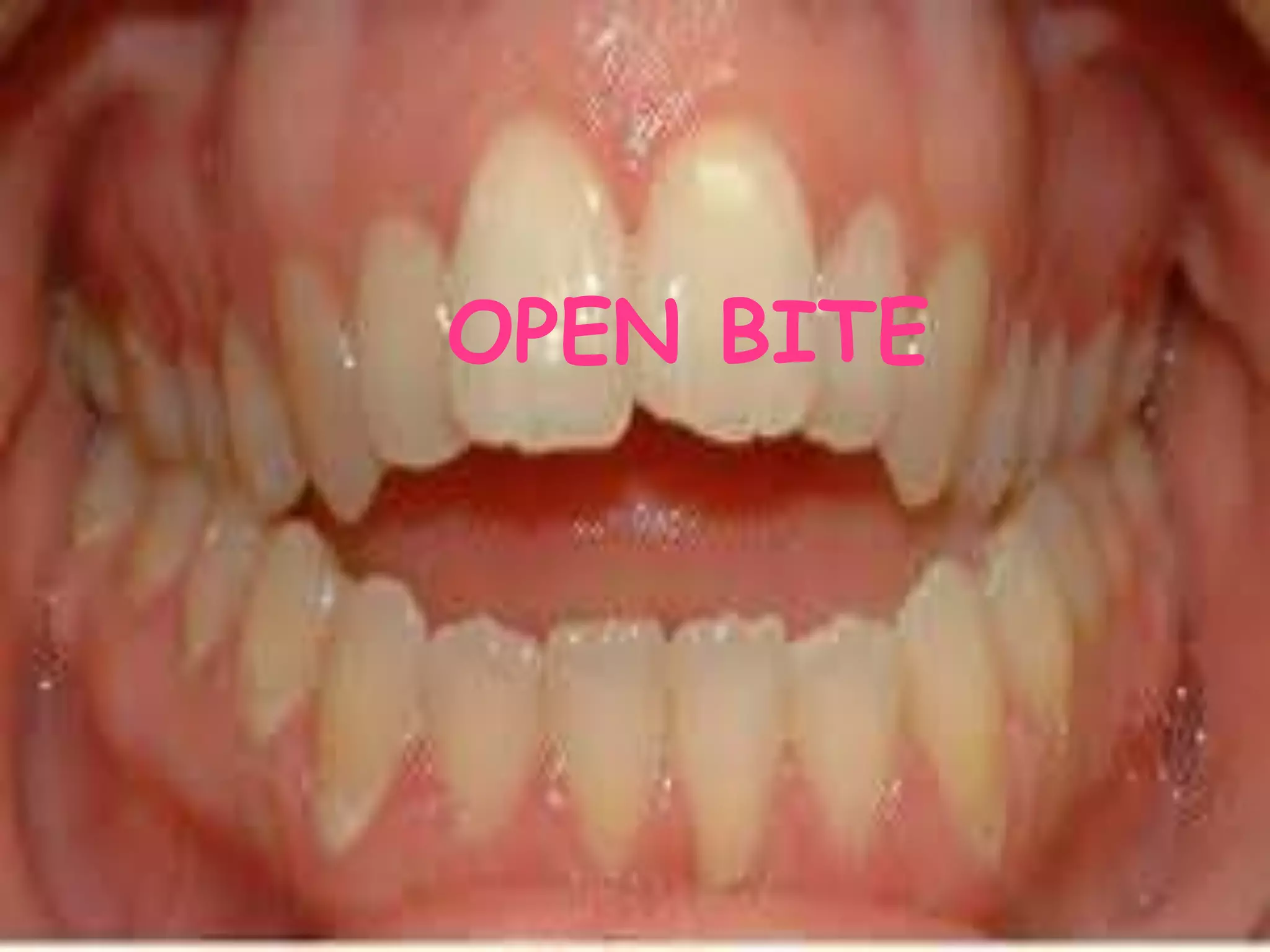 OPEN BITE
 