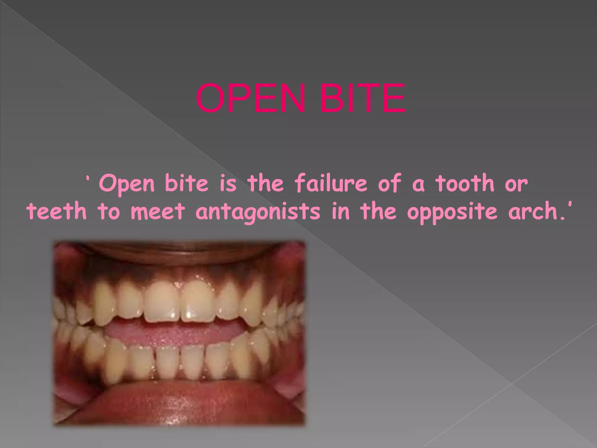 OPEN BITE
‘ Open bite is the failure of a tooth or
teeth to meet antagonists in the opposite arch.’
 