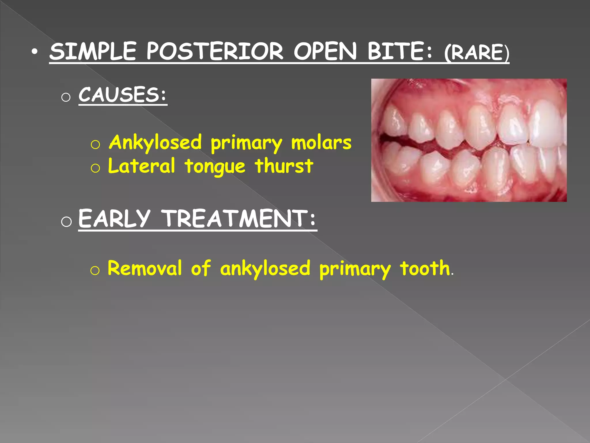 • SIMPLE POSTERIOR OPEN BITE: (RARE)
o CAUSES:
o Ankylosed primary molars
o Lateral tongue thurst
o EARLY TREATMENT:
o Removal of ankylosed primary tooth.
 