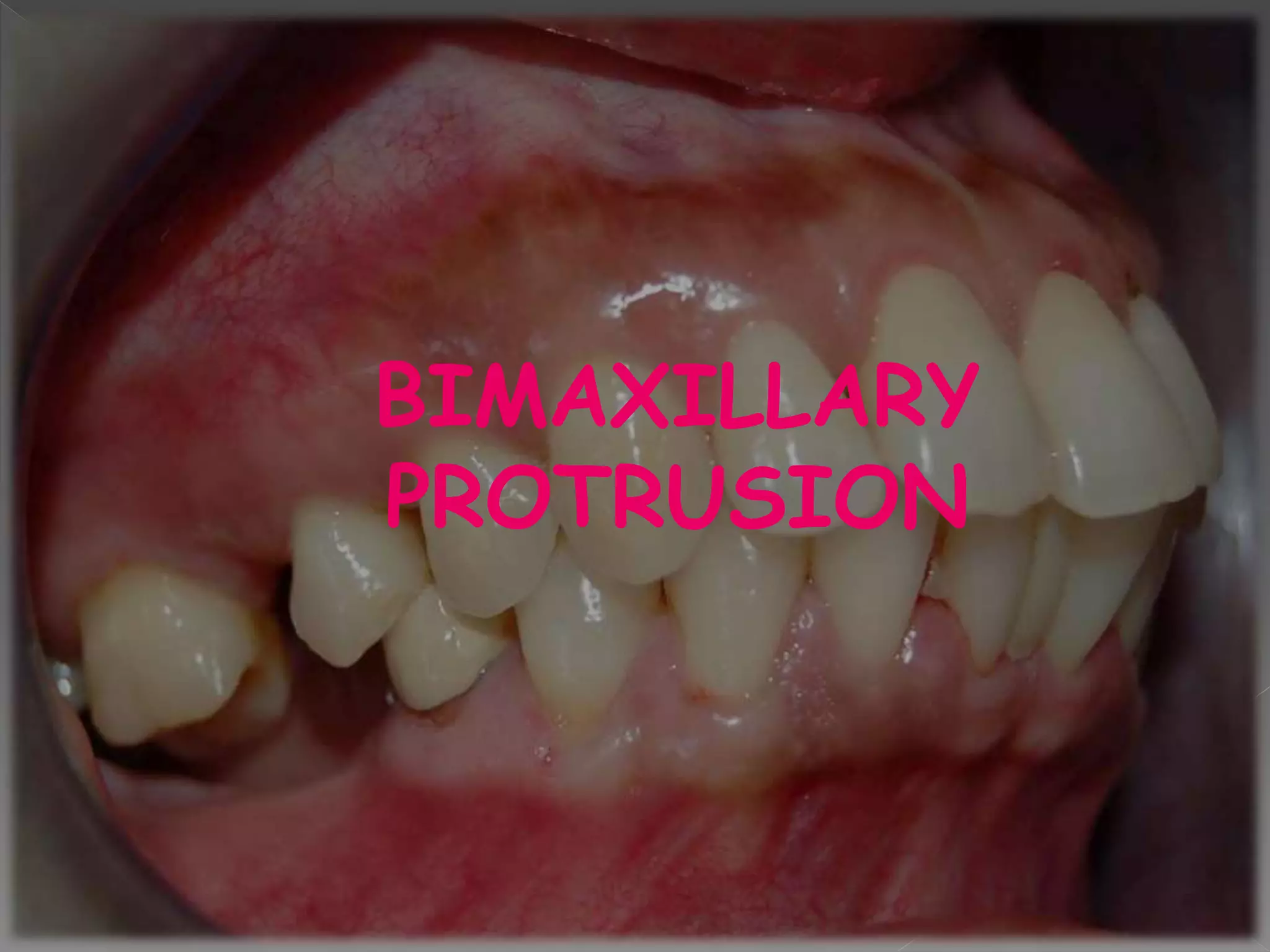 BIMAXILLARY
PROTRUSION
 