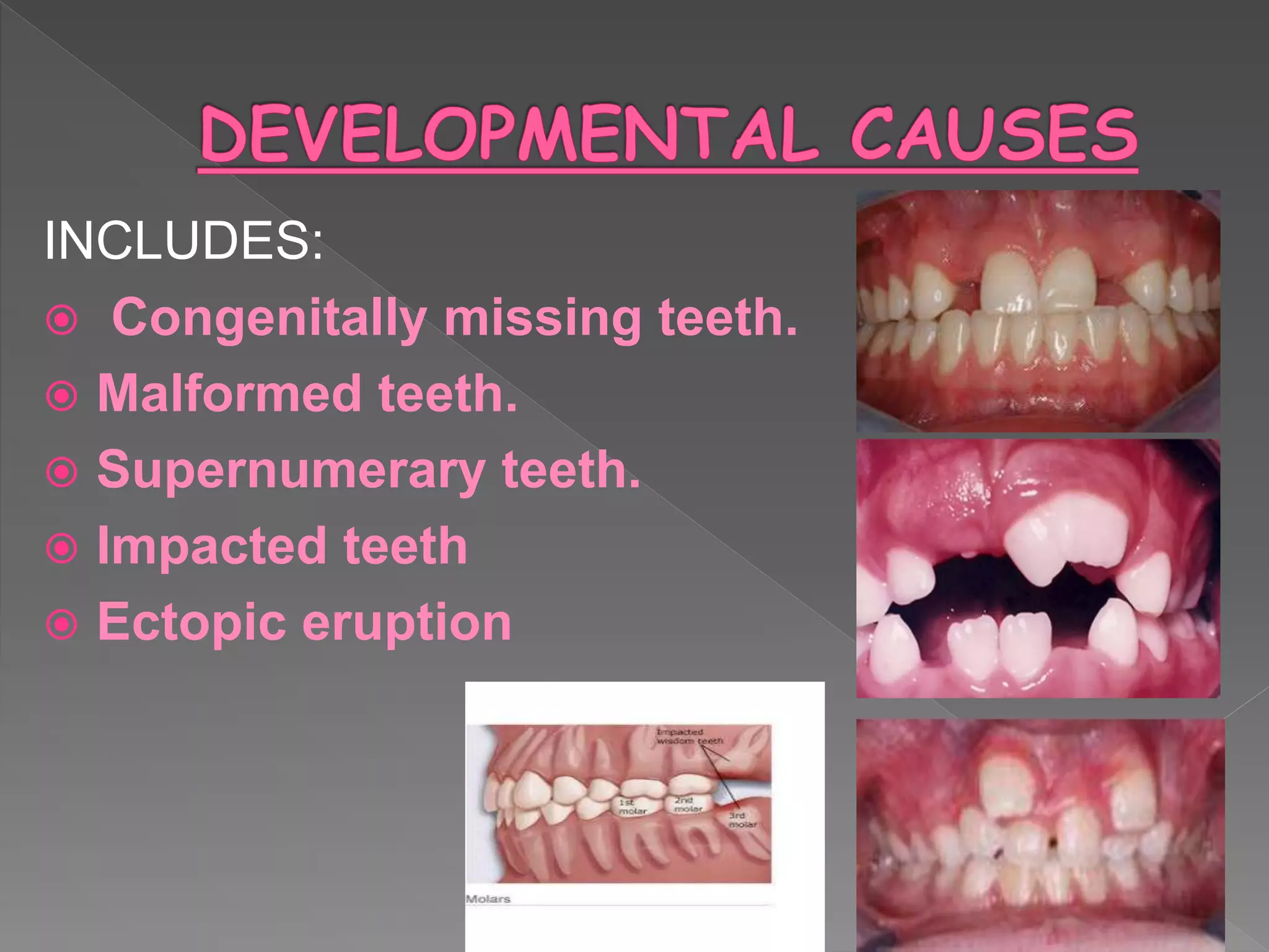 INCLUDES:
 Congenitally missing teeth.
 Malformed teeth.
 Supernumerary teeth.
 Impacted teeth
 Ectopic eruption
 
