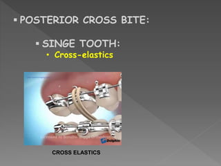 Management of class i malocclusion | PPTX